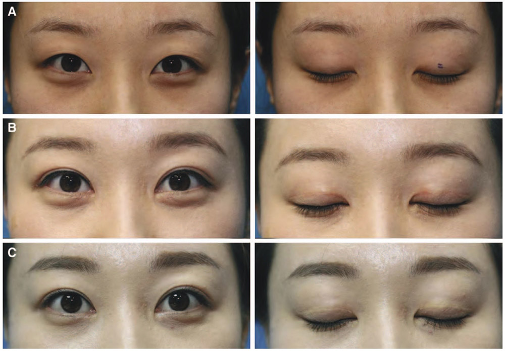 Double eyelid surgery pre and post-op photos