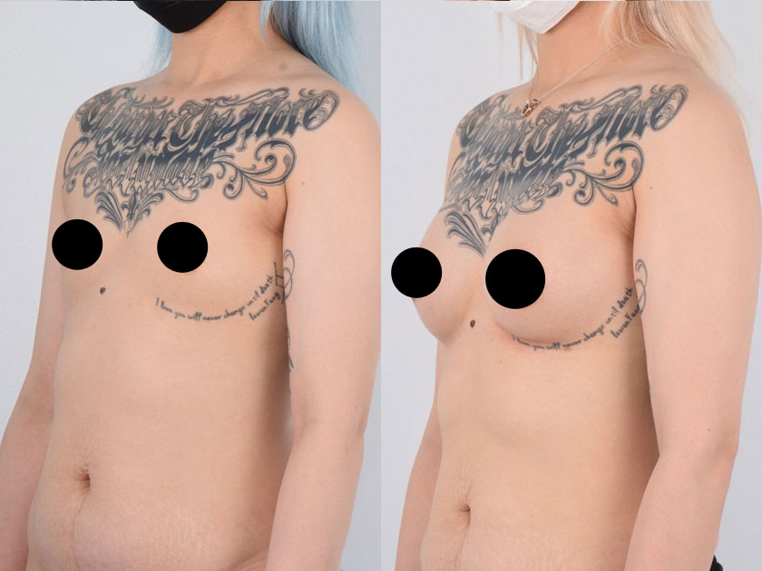 Orange County Breast Lift Surgeon Provides Patients with Superior Results