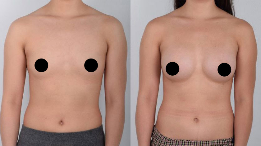 Even Plastic Surgeons Fooled by Natural-Looking Breast Implants