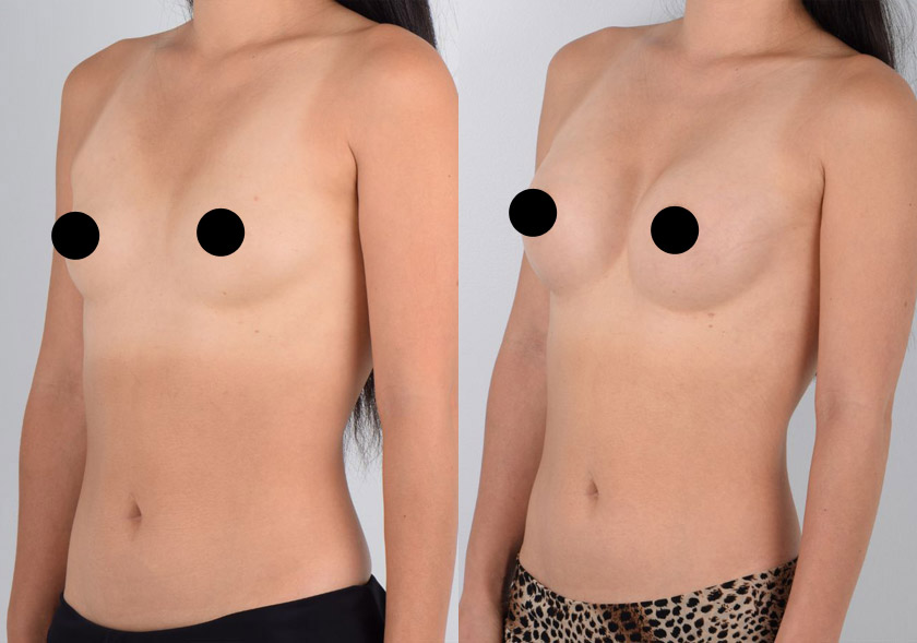 Direct to Implant Breast Reconstruction in Beverly Hills and Los