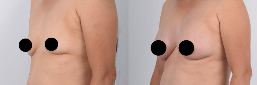 Direct to Implant Breast Reconstruction in Beverly Hills and Los