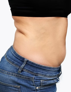 Tummy area before the Awake Liposuction