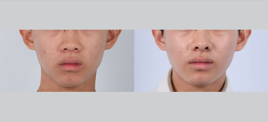 Chin Augmentation