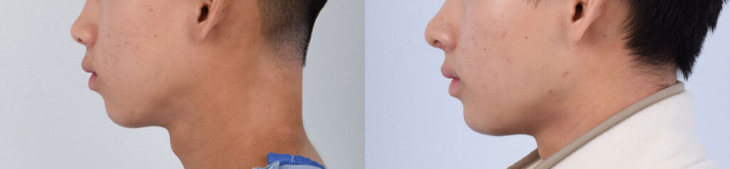 Chin Augmentation
   

