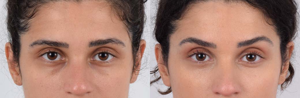 36-years old female represents before and after eyelid lift plastic surgery performed by Dr. Kenneth Kim