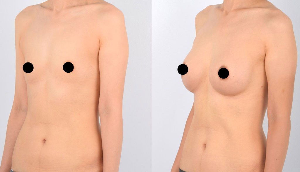 Smaller Breast Implants are more Popular