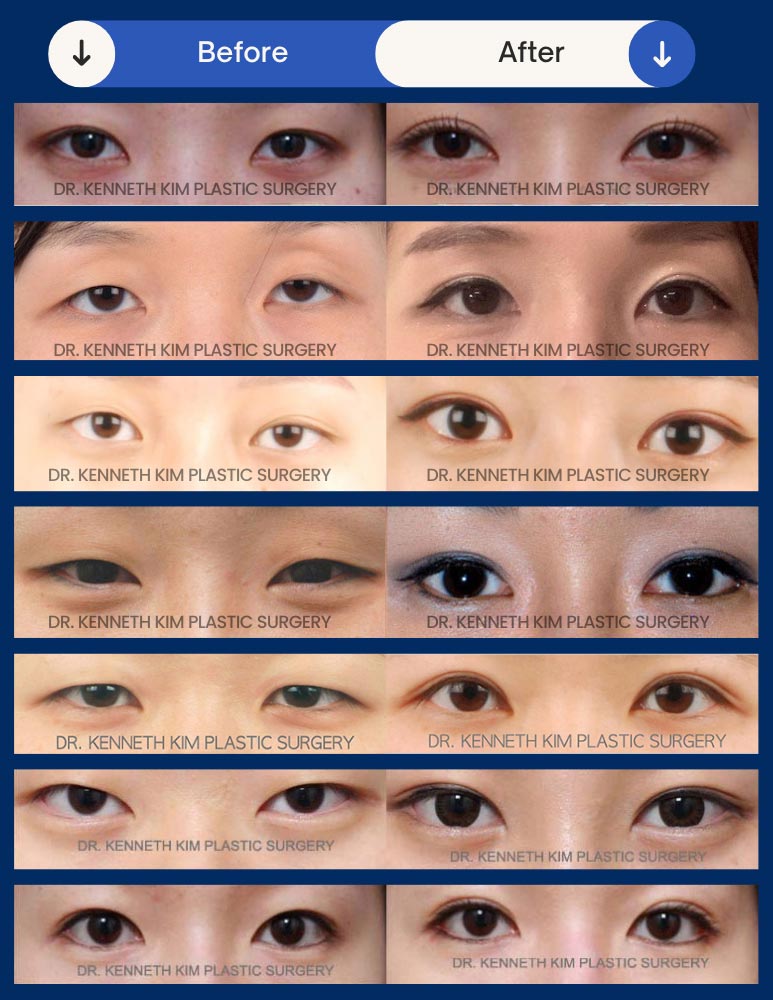 Double eyelid surgery before and after photos